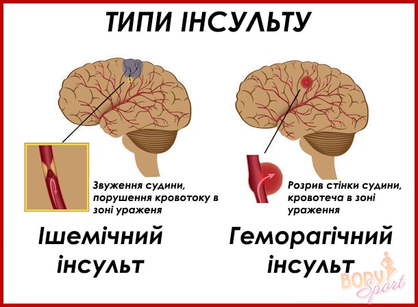 Типи інсульту